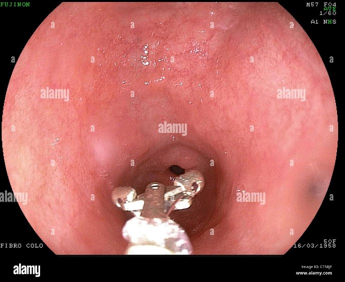 Biopsia dello stomaco durante una gastroscopia