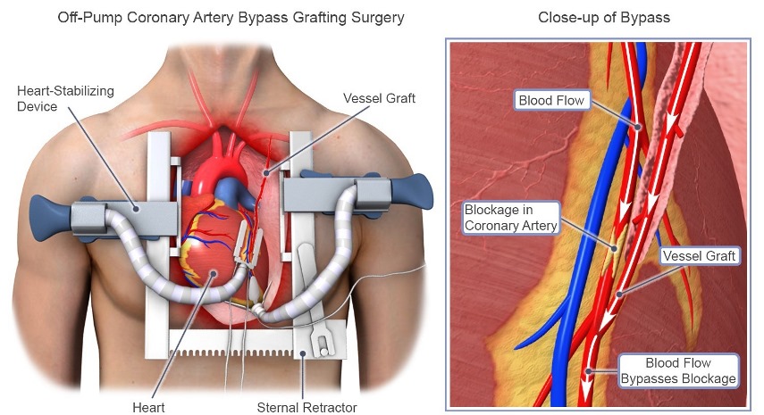 Bypass Coronarico