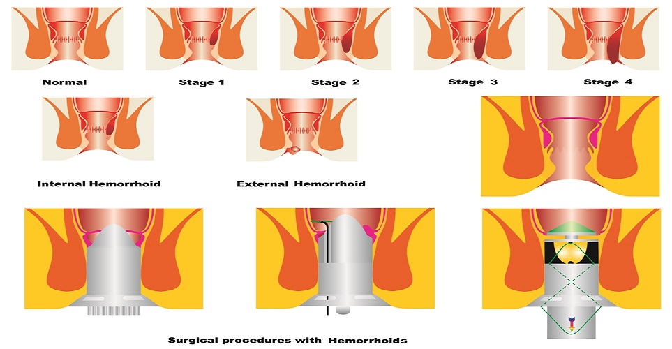 chirurgia laser emorroidi