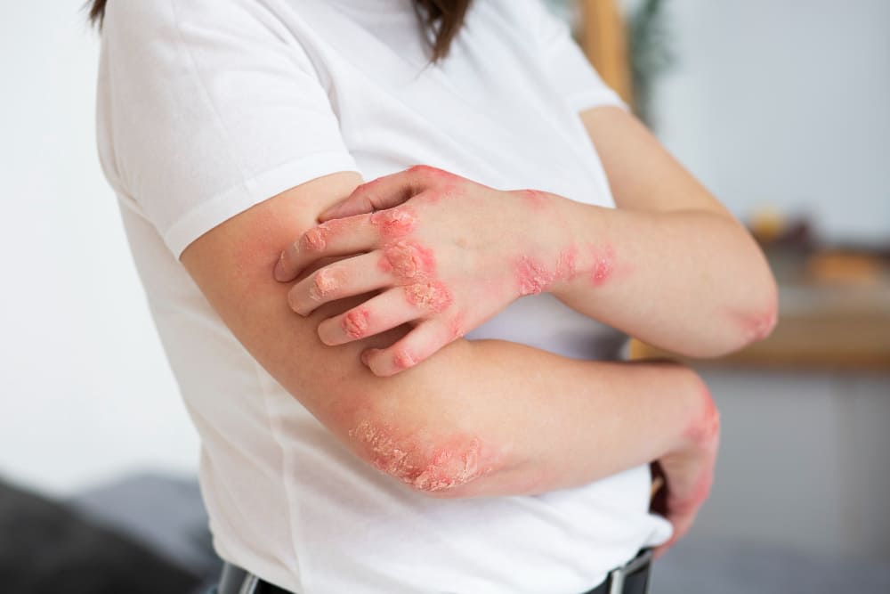 crioterapia dermatologica