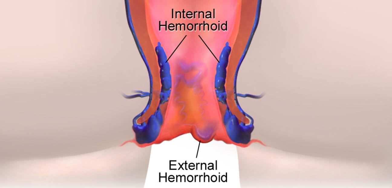 emorroidi interne ed esterne