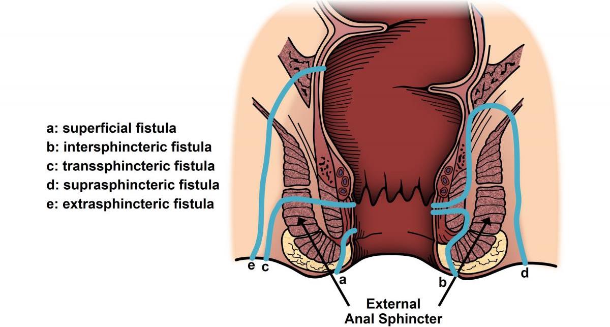 fistole anali