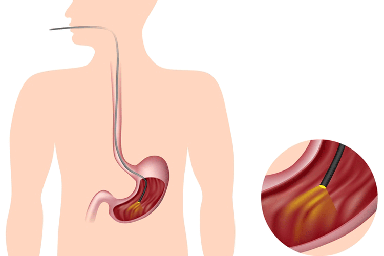 schema di una gastroscopia