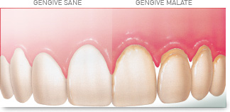 differenza tra gengive nere e gengive sane