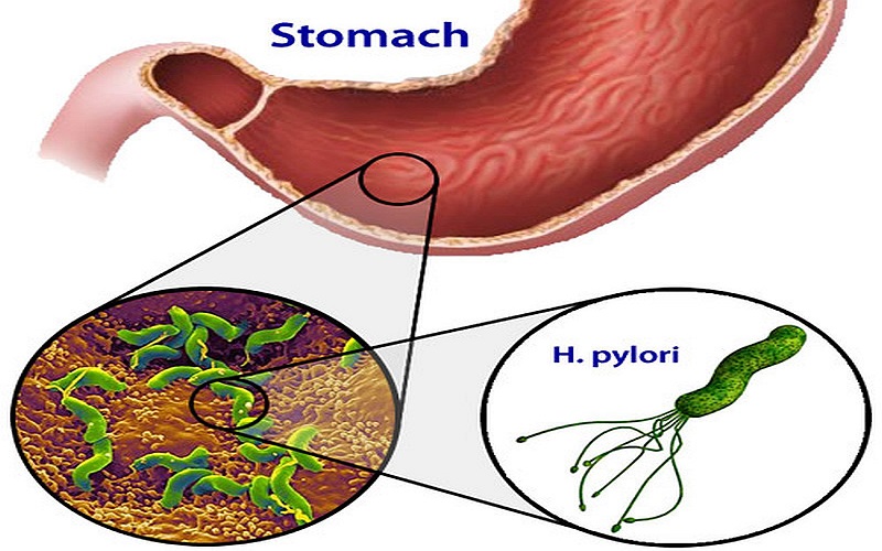 helicobacter pylori