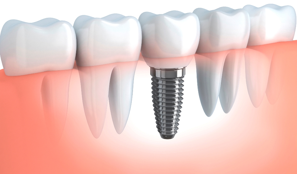 impianto dentale