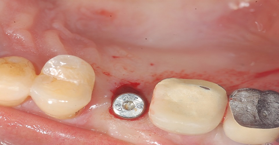 impianto tecnica transmucosa