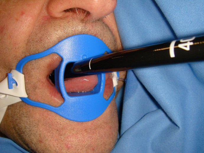 l'ingresso del gastroscopio nella bocca del paziente