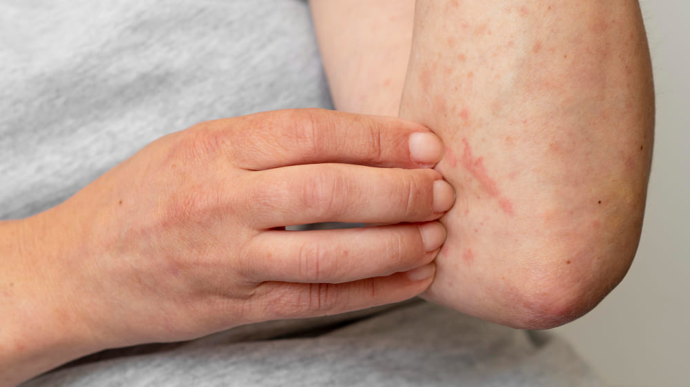 psoriasi guttata cura, quanto dura e cause