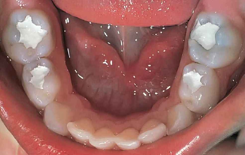 trattamento denti cariati